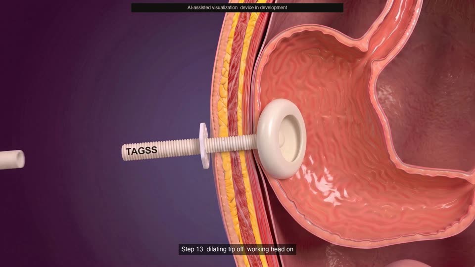 Endo-TAGSS: The Procedure — still